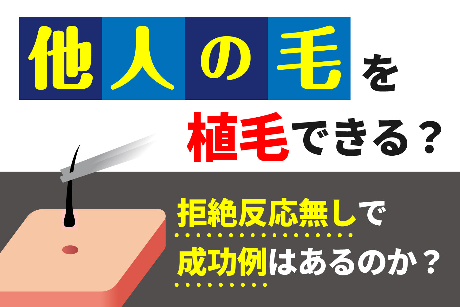 他人の毛を植毛できる？拒絶反応無しで成功例はあるのか？