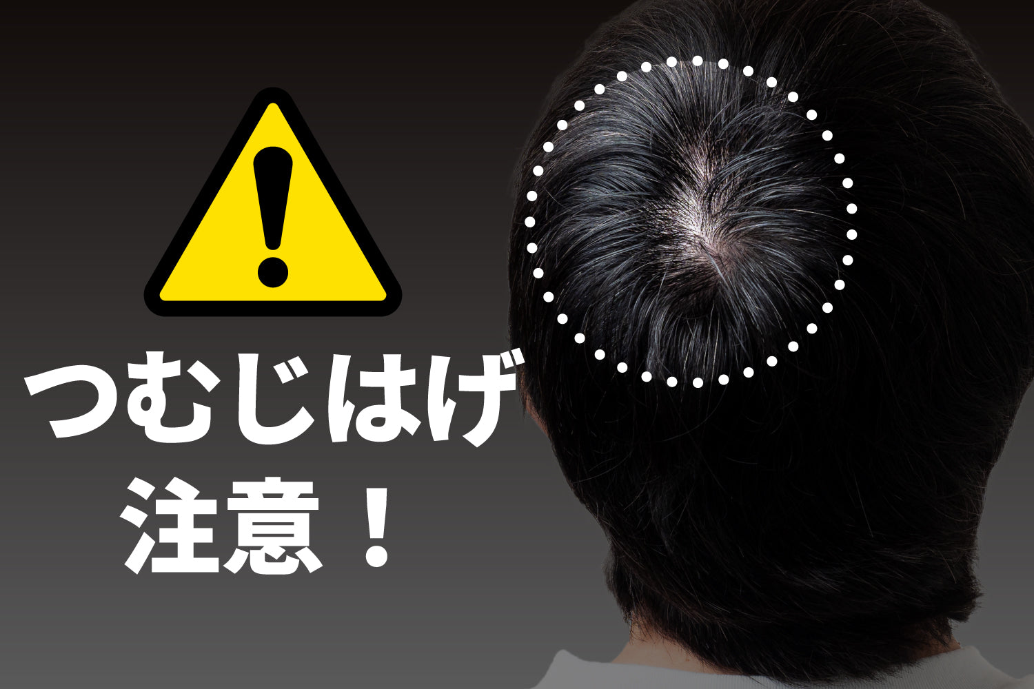 つむじはげとはどんな状態？育毛シャンプーで治る？