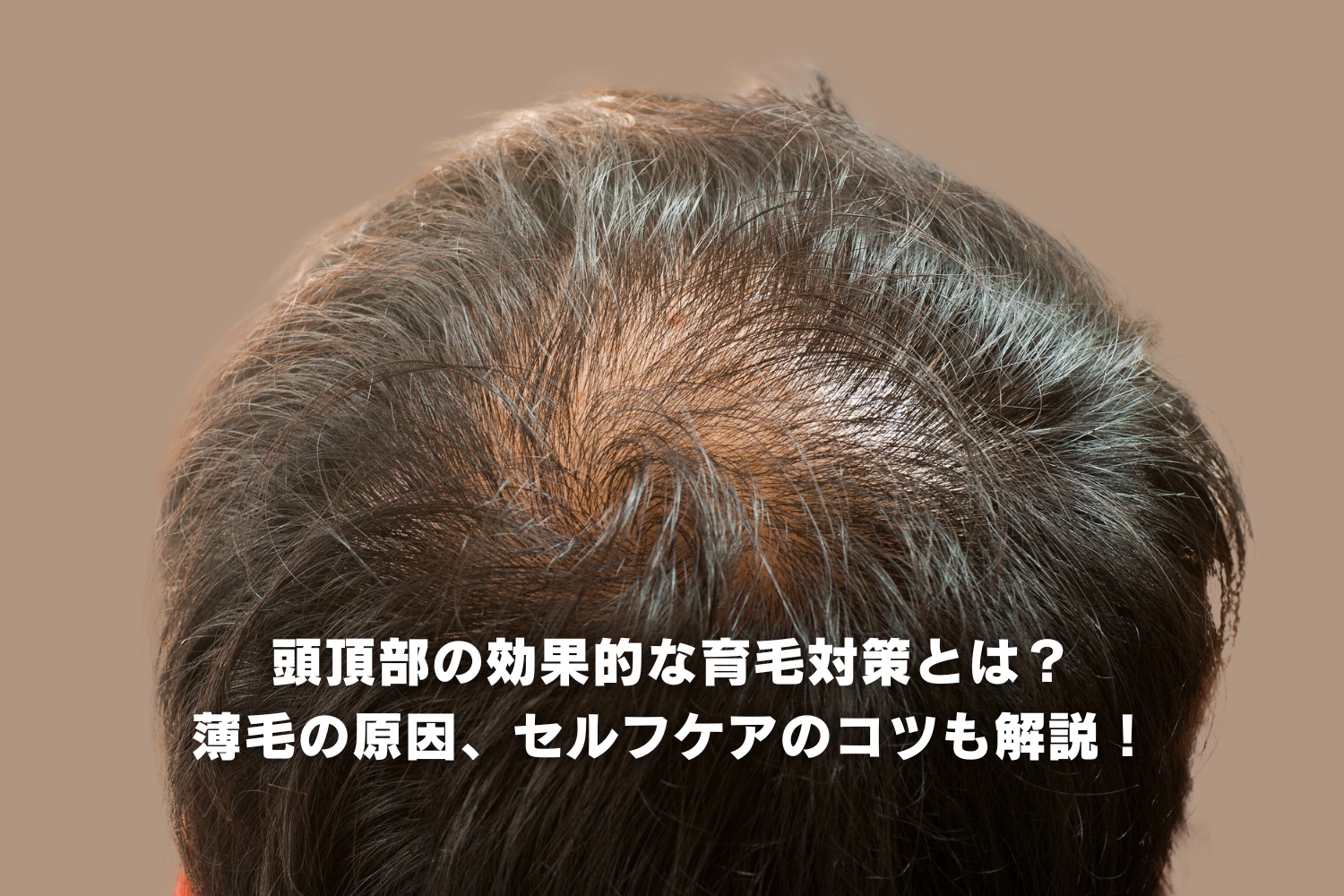 頭頂部の効果的な育毛対策とは？ 薄毛の原因、セルフケアのコツも解説！